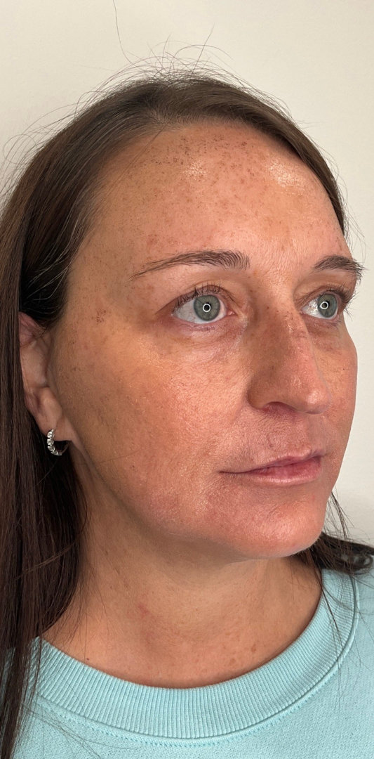 Sciton MOXI Before & After Image