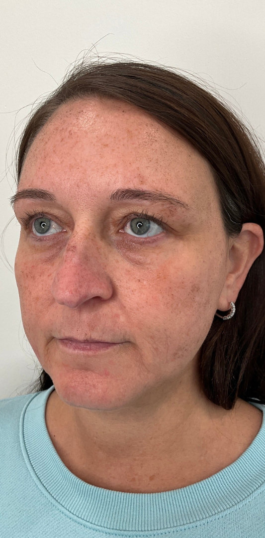 Sciton MOXI Before & After Image