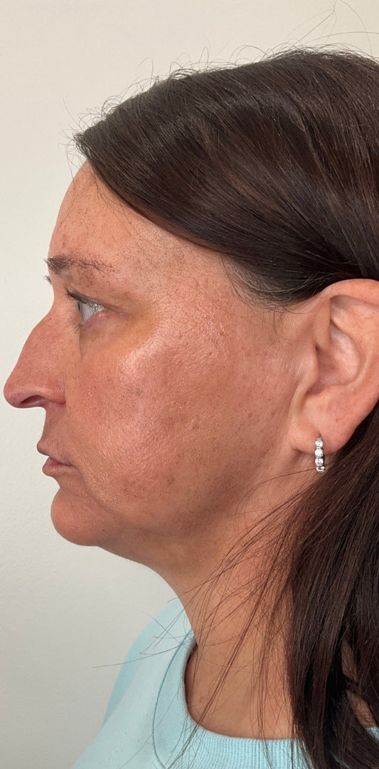 Sciton MOXI Before & After Image