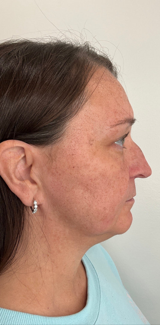 Sciton MOXI Before & After Image