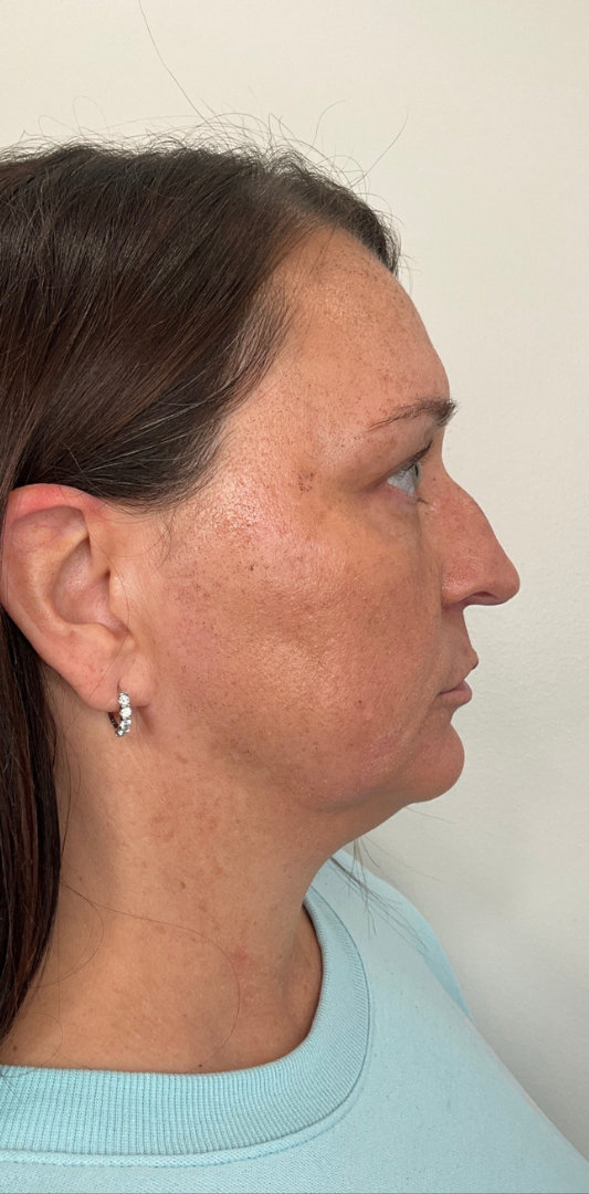 Sciton MOXI Before & After Image