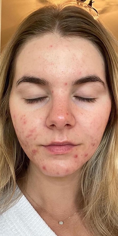 Acne Treatment Before & After Image