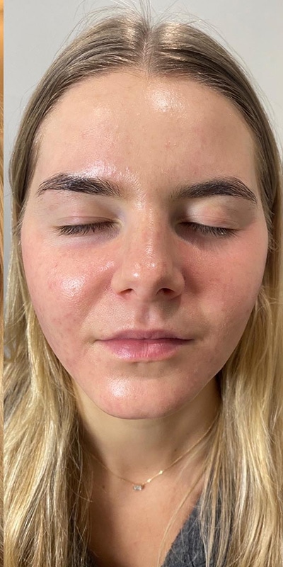 Acne Treatment Before & After Image