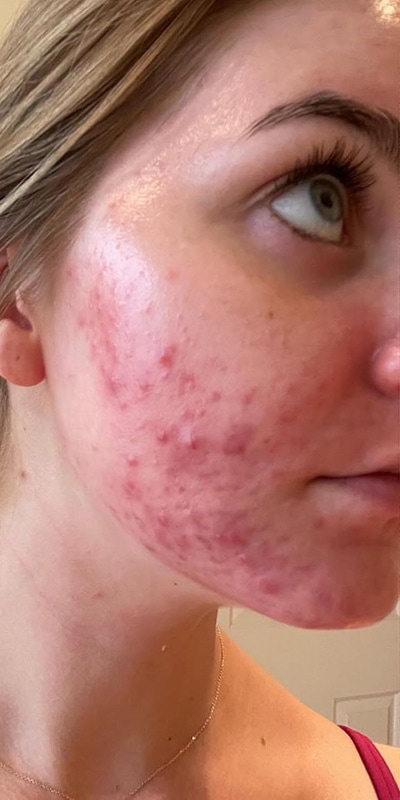 Acne Treatment Before & After Image