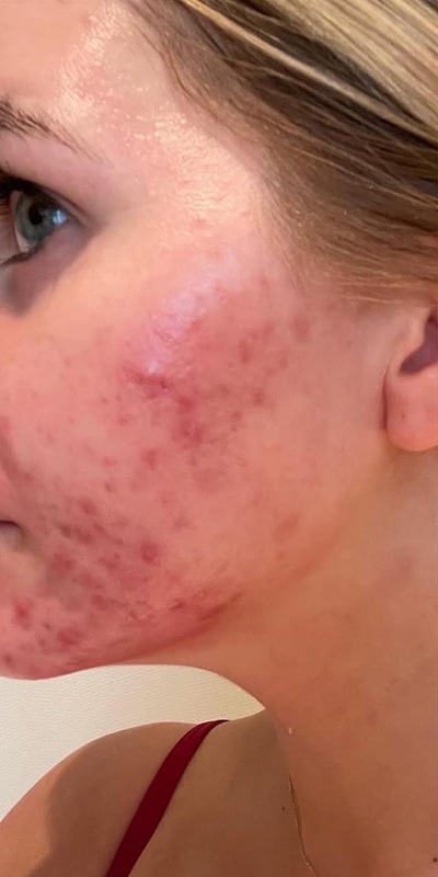 Acne Treatment Before & After Image