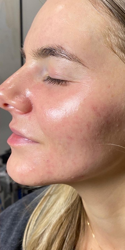 Acne Treatment Before & After Image