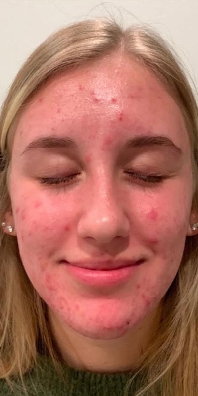 Acne Treatment Before & After Image
