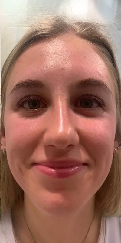 Acne Treatment Before & After Image