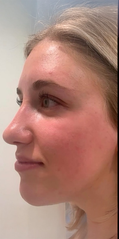Acne Treatment Before & After Image