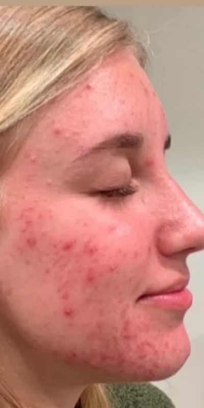 Acne Treatment Before & After Image