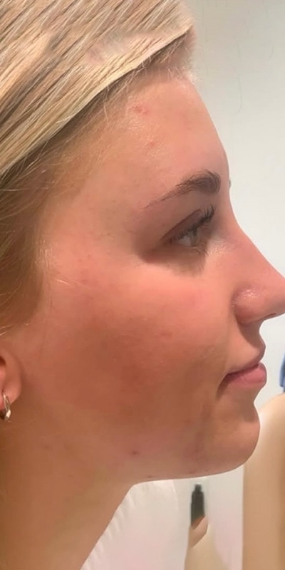 Acne Treatment Before & After Image