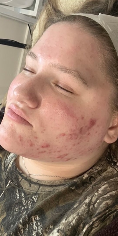 Acne Treatment Before & After Image