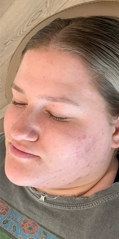 Acne Treatment Before & After Image