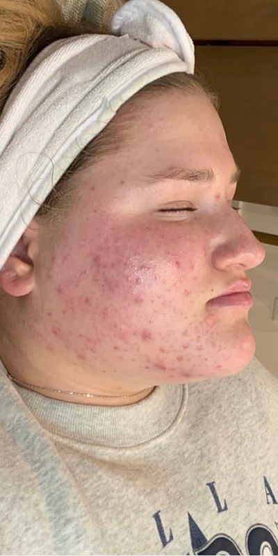 Acne Treatment Before & After Image