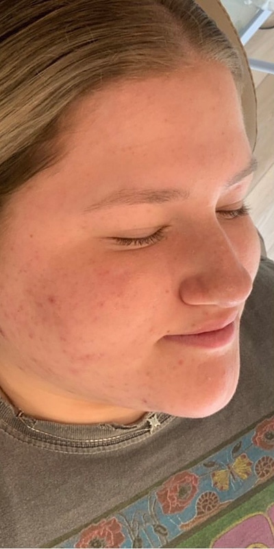 Acne Treatment Before & After Image