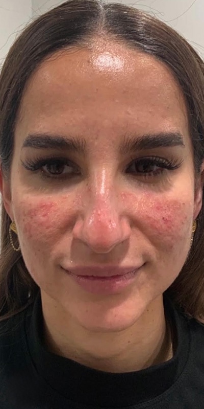 Acne Treatment Before & After Image