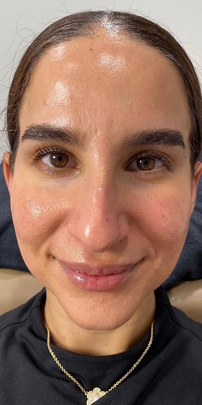 Acne Treatment Before & After Image