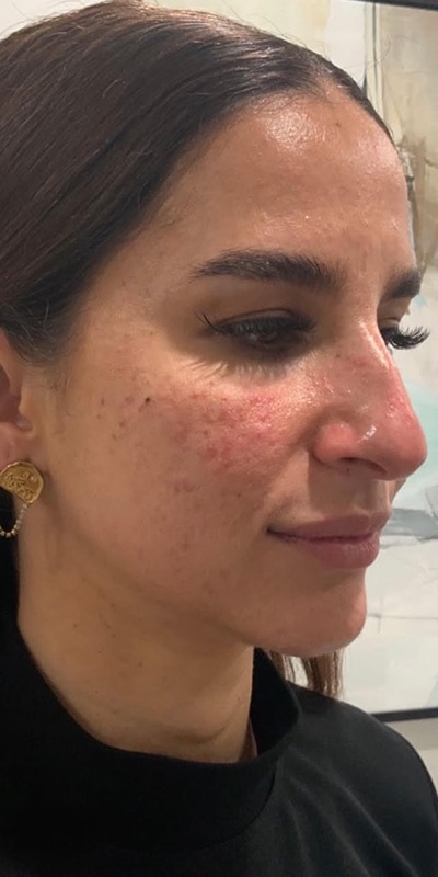 Acne Treatment Before & After Image