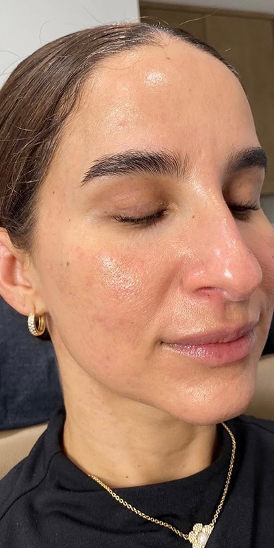 Acne Treatment Before & After Image