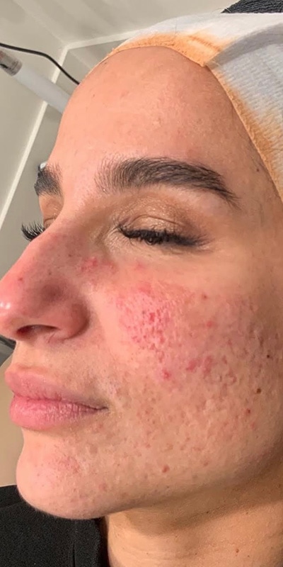 Acne Treatment Before & After Image