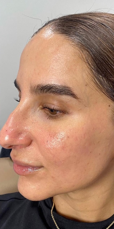 Acne Treatment Before & After Image