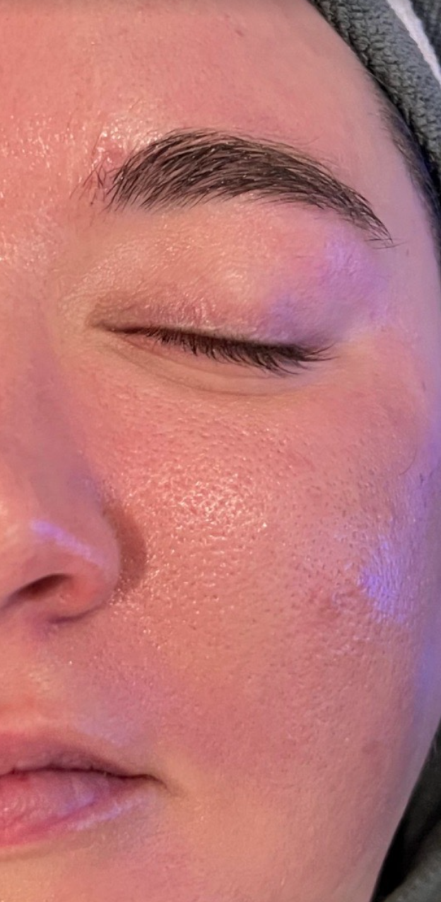 Hydrafacial Before & After Image