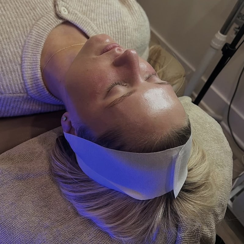 Hydrafacial Before & After Image