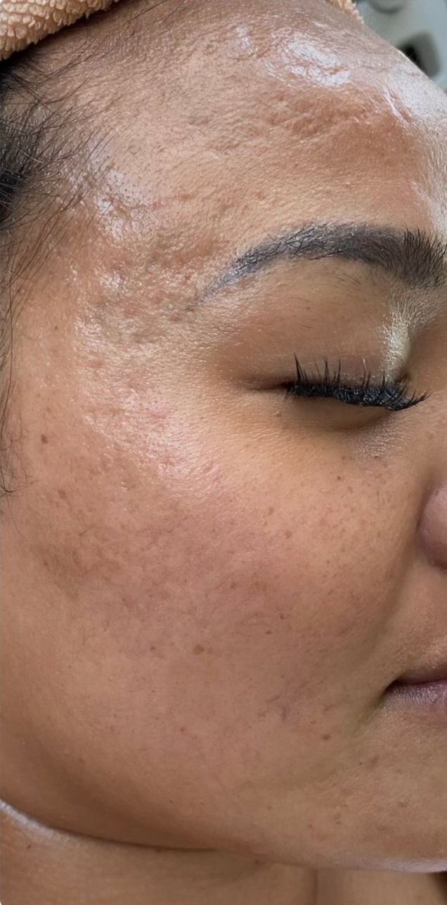 Microneedling Before & After Image