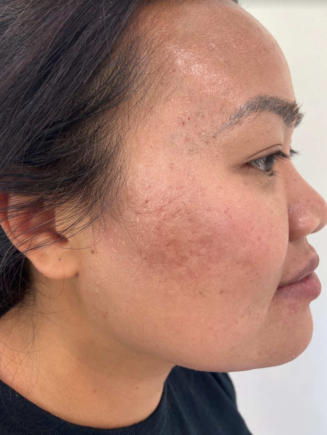 Microneedling Before & After Image